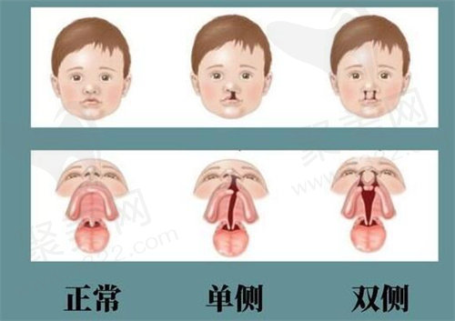 重庆松山医院唇裂修复