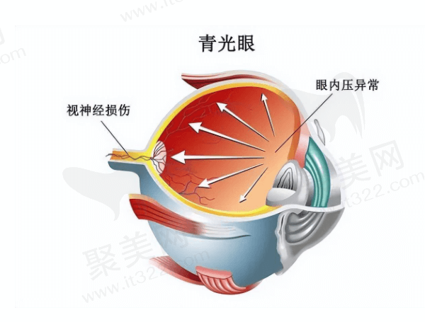 青光眼激光近视手术治疗后还会复发吗？