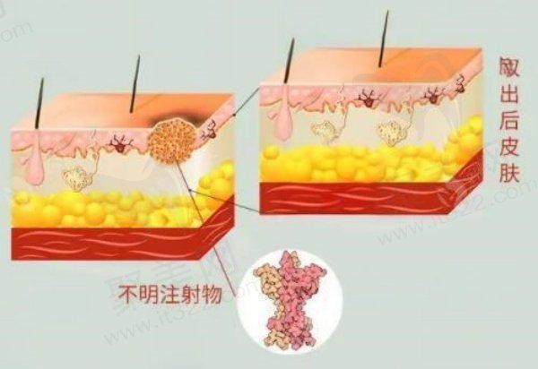 武汉仁爱时光生长因子取出医生