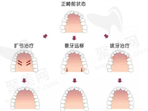 广州穗华口腔医院牙齿矫正要多少钱