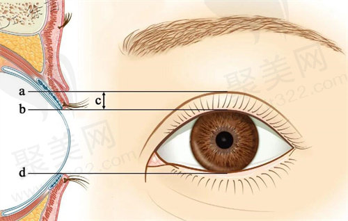 张姣姣医生做双眼皮手术可综合修复多项眼部缺陷