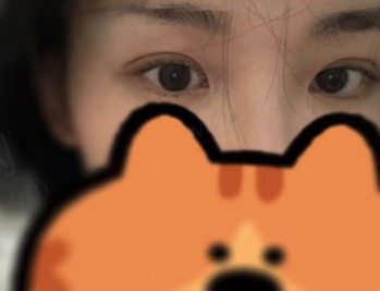 佛山华美双眼皮