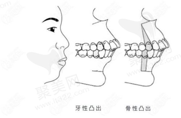 骨性前凸和牙性前突一样吗