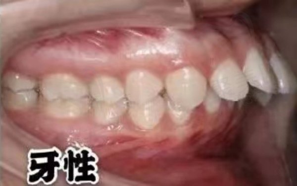 牙性前突
