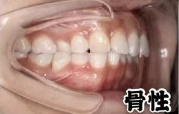 骨性前凸