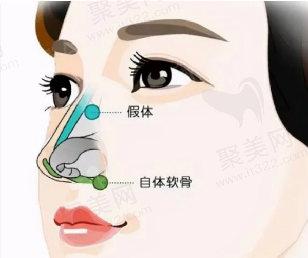 苏州芘丽肤华美做鼻子技术好