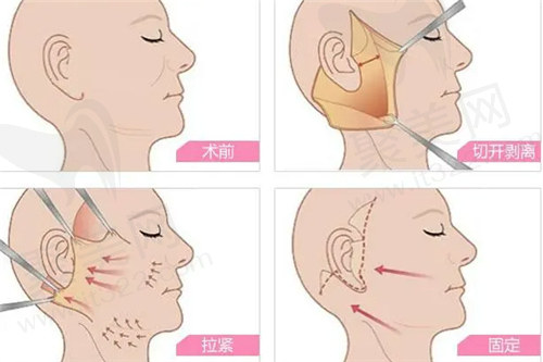 沈阳杏林整形医院崔昌墉拉皮怎么样？