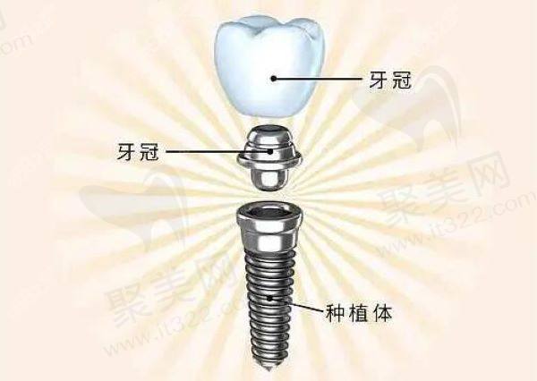南昌大学抚州医学院附属口腔种植牙多少钱