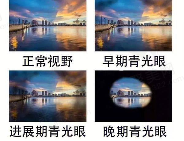 青光眼