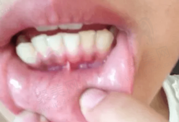 牙龈发紫黑