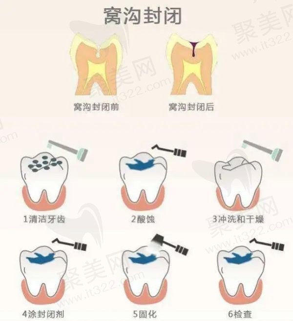 窝沟封闭的操作流程介绍