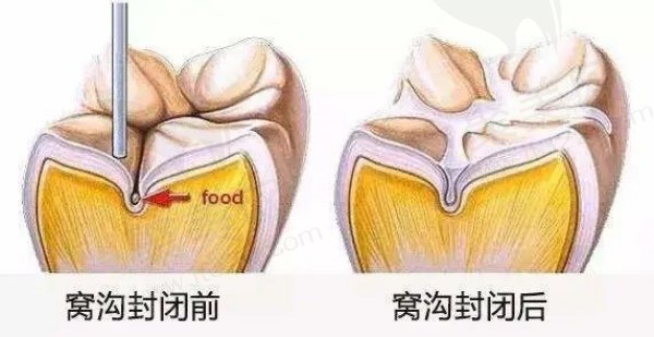 窝沟封闭的害处和好处分析