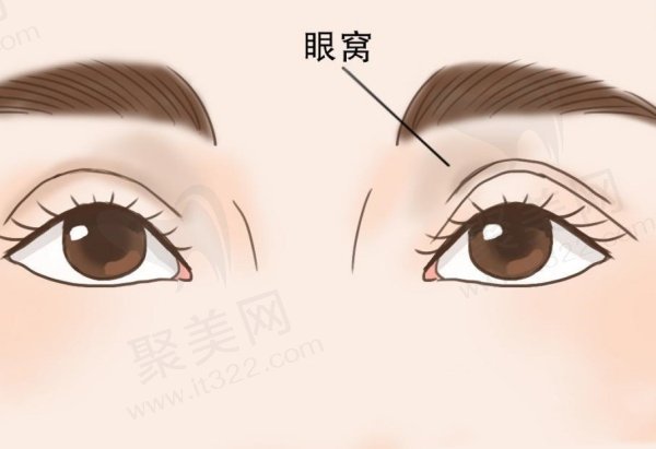 眼睛凹陷怎么恢复饱满