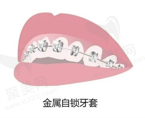 成都布莱梅口腔医院数字化牙齿矫正技术娴熟