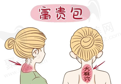 佛山做富贵包手术哪里好？