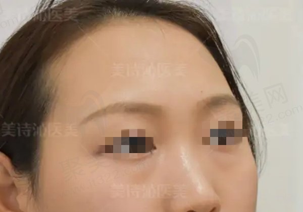 云南美诗沁于海成眼袋手术怎么样