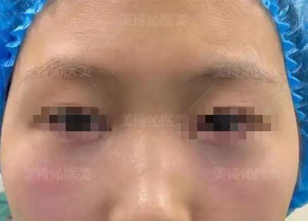 云南美诗沁于海成眼袋手术怎么样