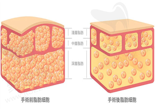 深圳艺星吸脂可靠吗