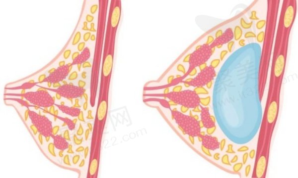 广州丽合肖强隆胸怎么样 广州丽合肖强隆胸怎么样