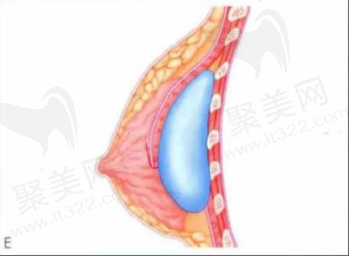 南京美莱夏建军隆胸价格
