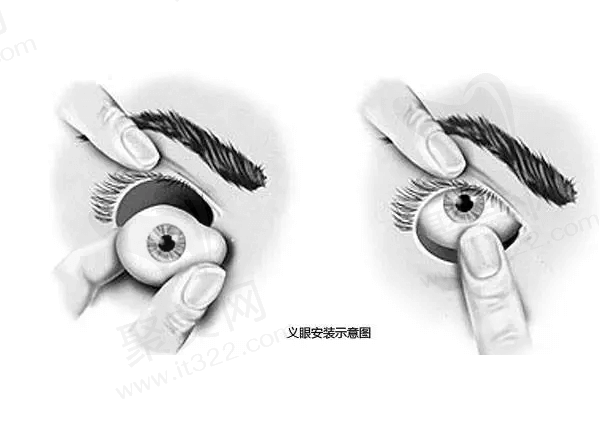义眼整形手术哪个医院好一点？