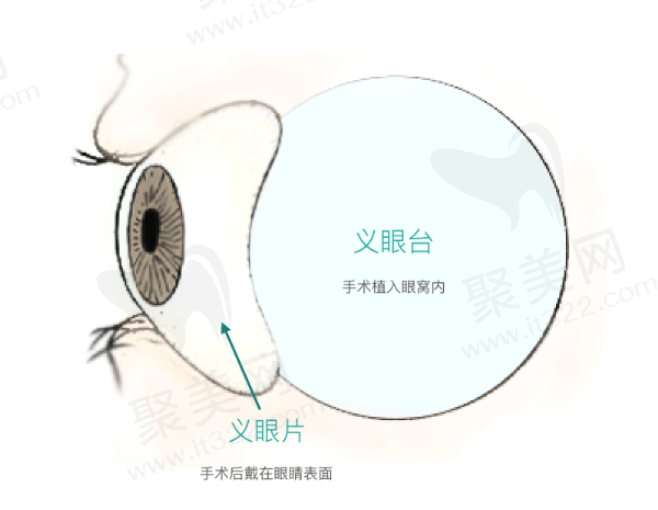 国内义眼手术价格一览表