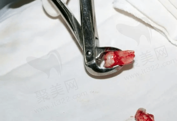 拔牙