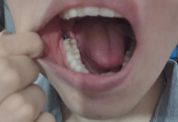拔牙十天后牙窝应是啥颜色