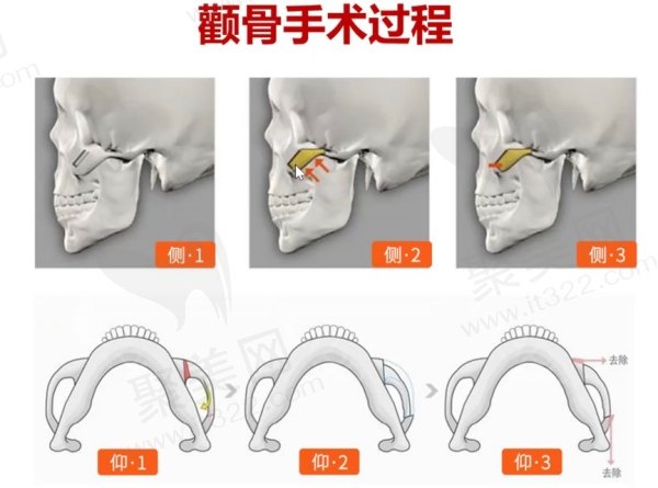 韩妃柳超磨骨手术好吗