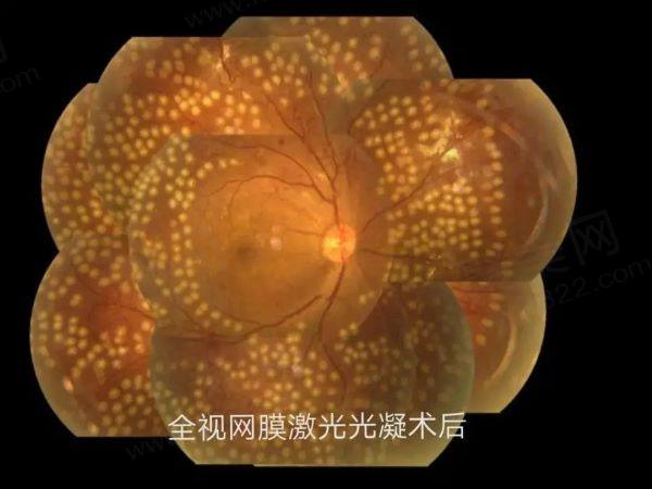 视网膜光凝术有必要做吗