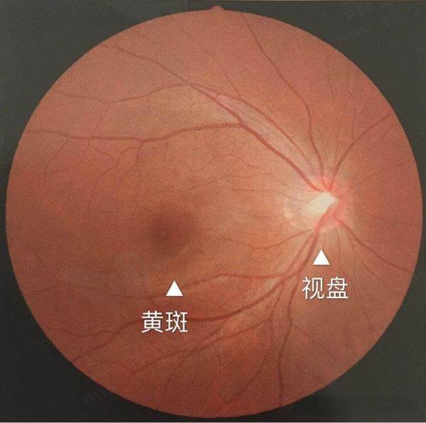 眼底黄斑病变
