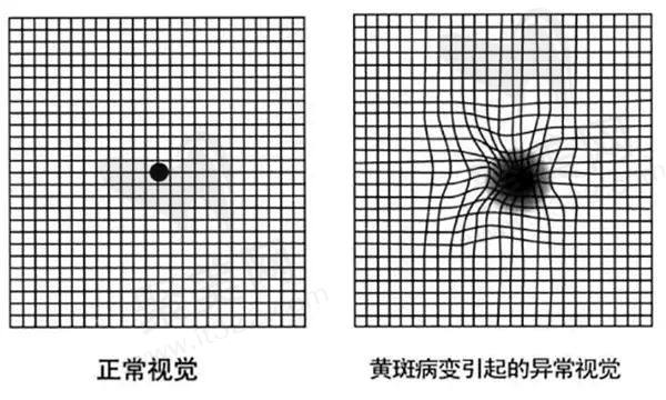 眼底黄斑病变的早期症状