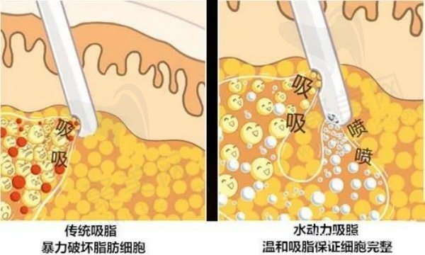 朱良平面部吸脂价格