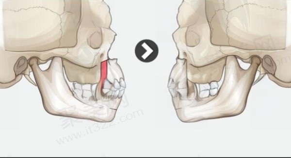 何锦泉医生做正颌手术目前无失败<span style=