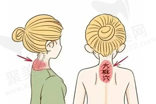 黄学峰一针去除富贵包