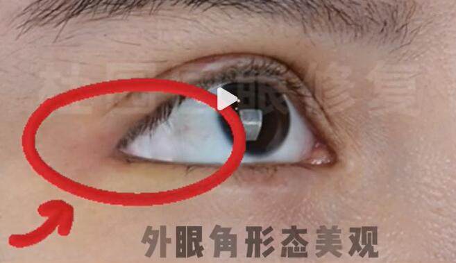 杜园园双眼皮修复技术怎么样