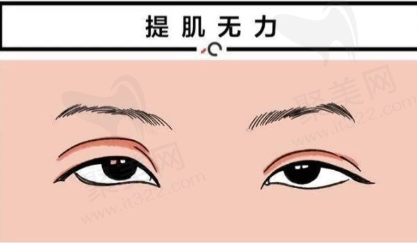 海南海口华美赵晓兰上睑提肌价格