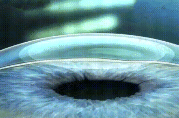 广州视百年眼科蔡司全激光近视手术多少钱？
