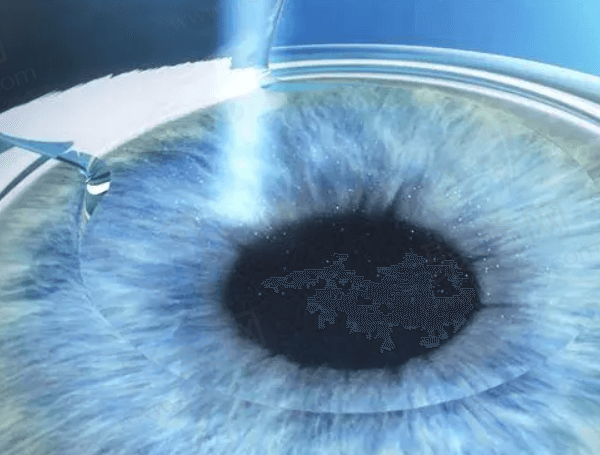 广州视百年眼科近视手术怎么样？