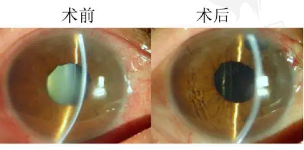 应该怎样诊断晶状体脱位所致青光眼