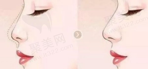 郑州东方吴振做鼻子实例