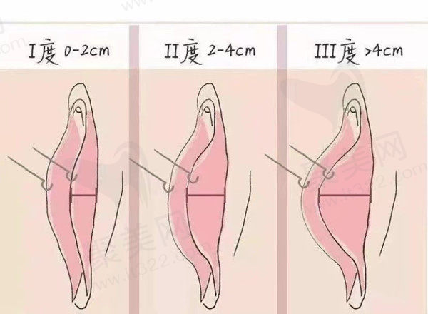 郑州整形医院私密整形