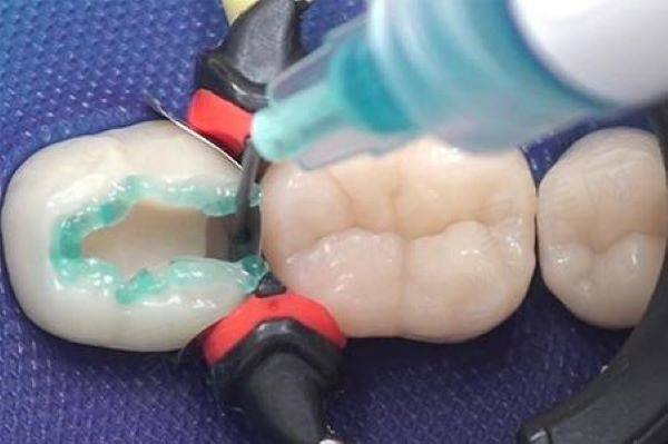 杭州口腔医院越城分院补牙价格
