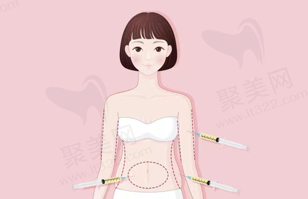佛山做腰腹抽脂排名前五