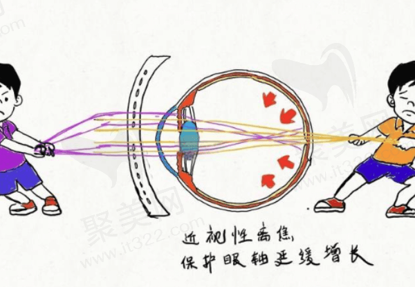 离焦镜能控制近视吗？