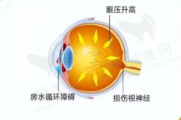 青光眼的症状