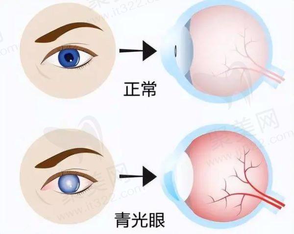 青光眼和正常眼睛
