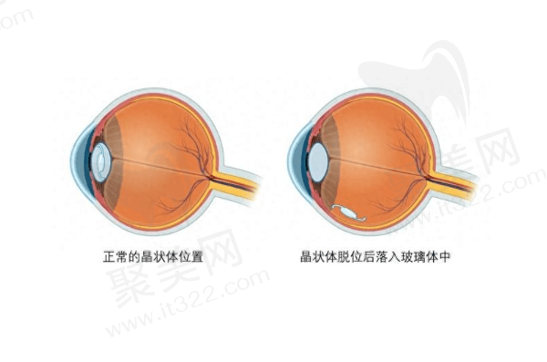 晶体异位和脱位可以引发什么并发症？