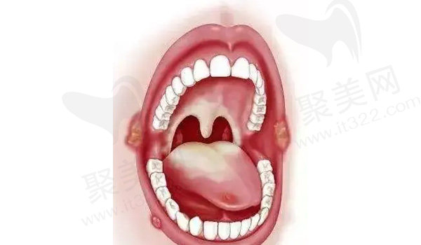 牙齿咬到口腔内壁发生口腔溃疡