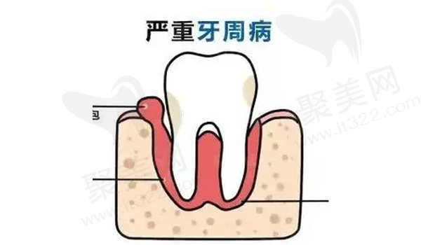 牙周病的出现也会有咬到口腔内壁的情况
